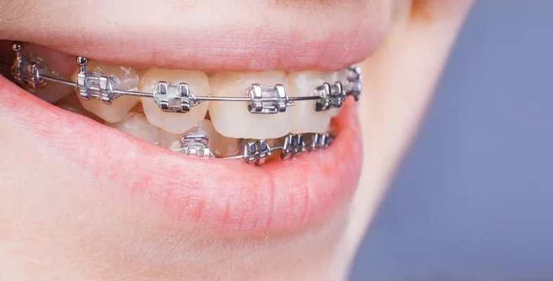 اسعار تقويم الاسنان في عمان