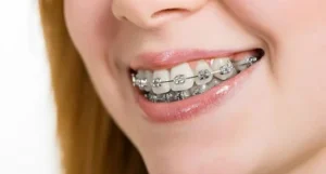 اسعار تقويم الاسنان في عمان