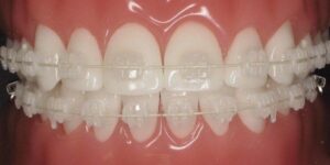 تقويم الاسنان السيراميك