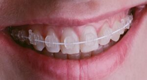 تقويم الاسنان السيراميك